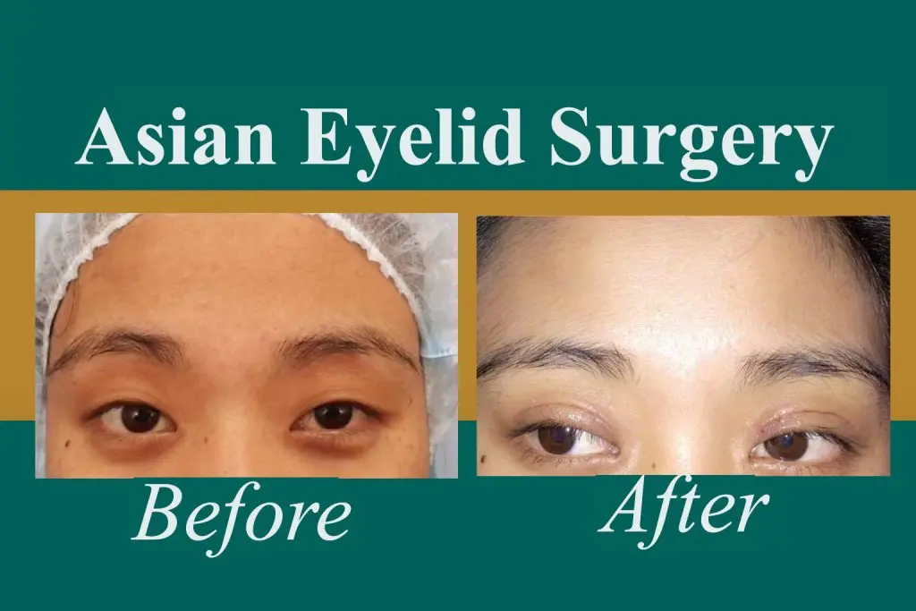 Before Treatment