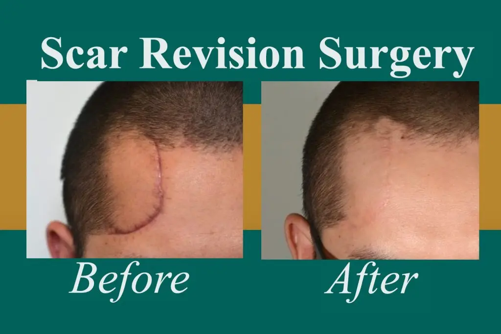 After Treatment
